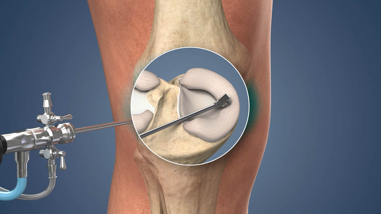 Meniscus tear repair