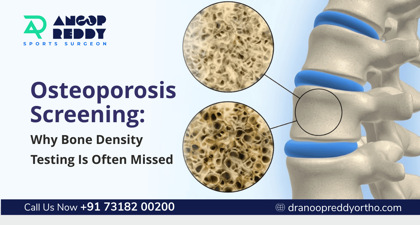 Osteoporosis Screening: Why Bone Density Testing Is Often Missed